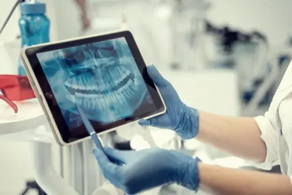 iTero Intraoral Scanners for Sale